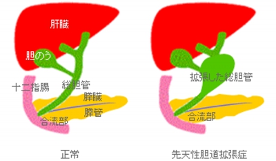 先天性胆道拡張症.gif