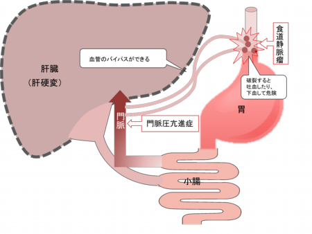 門脈圧亢進症と食道静脈瘤.png